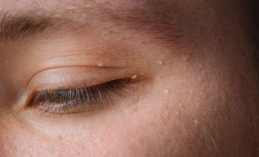 Apa Penyebab Milia di Wajah? Ini Penjelasan nya!