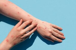 Balam Masih ‘Bebas’ Cacar Monyet